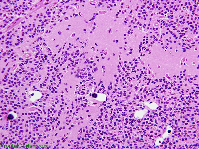 Central neurocytoma, H&E stain x200